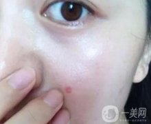 點(diǎn)痣后可以用護(hù)膚品嗎？有什么注意事項(xiàng)？