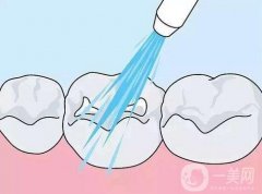 洗牙的感覺(jué)是不是很痛?