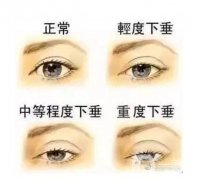 外眼角下垂嚴(yán)重可以做提拉嗎?