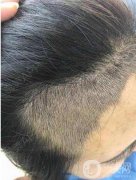頭發(fā)種植后會(huì)不會(huì)留疤?種發(fā)前后注意事項(xiàng)有哪些?
