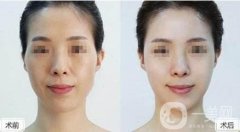 填充太陽(yáng)穴有危險(xiǎn)嗎?需要注意些什么?