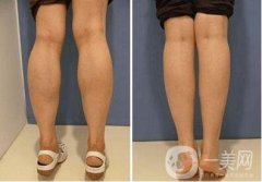 注射瘦腿和抽脂瘦腿哪個(gè)更好?