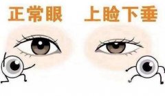 上瞼下垂能不做手術(shù)嗎?上瞼下垂不做手術(shù)該怎么改良?