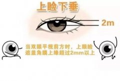 上瞼下垂矯正術(shù)需要多少錢(qián)?影響上瞼下垂手術(shù)價(jià)格的因素