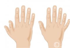 多指矯正術有哪些？手術后需要注意什么？