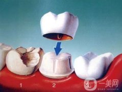 美容冠矯正牙的優(yōu)缺點是什么？美容冠矯正牙齒好嗎？