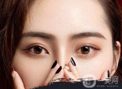 三點(diǎn)雙眼皮多少錢?韓式三點(diǎn)雙眼皮恢復(fù)快嗎?