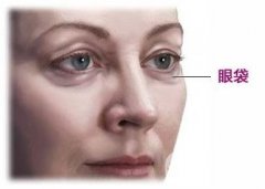 如何去除眼睛下面的眼袋呢?以及如何護(hù)理呢?