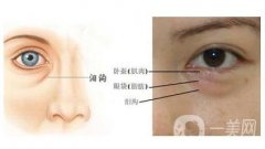 去眼袋多少錢?去做眼袋手術(shù)需要注意什么?