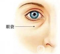 下眼袋切除前后需要注意什么?
