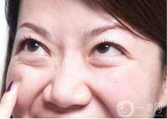 怎么才能去眼袋?外切眼袋后需要注意什么?
