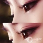 *雙眼皮是埋線的嗎?和埋線雙眼皮有什么不同?