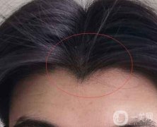 種植美人尖后的好處有哪些？種植美人尖后有什么危害嗎？