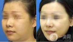 面部光纖溶脂會反彈嗎?光纖溶脂的原理是什么?