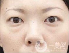 抽脂去眼袋多少錢?抽脂去眼袋多久可以恢復(fù)?