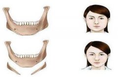 磨骨會改變臉型嗎?削骨和磨骨哪個更危險一些?