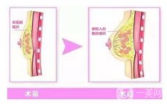 上海自體脂肪隆胸價格是多少?自體脂肪豐胸*果嗎?