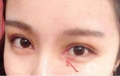 開內眼角和外眼角有什么區(qū)別?