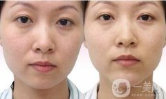 溶脂會反彈嗎?溶脂后如何避免反彈?