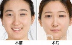 面部吸脂多少錢?面部吸脂貴嗎?