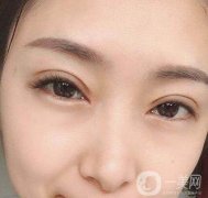 開眼角這些事兒一定要注意了!