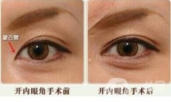 開外眼會收縮還有必要開嗎?哪些人不適合開外眼角?