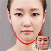 怎么瘦臉?瘦臉注射和面部吸脂哪個更適合你?