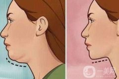 上海臉頰吸脂價格貴嗎?