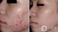 果酸換膚貴嗎?一次多少錢?