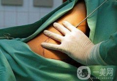 腰腹吸脂多久見?腰腹吸脂果好嗎?