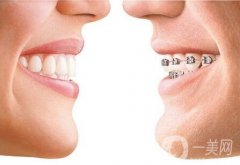 矯正牙齒要多少錢?矯正牙齒需要多長(zhǎng)時(shí)間?