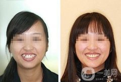 矯正牙齒的方法有哪些?矯正牙齒的三種常用方法