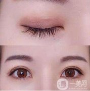 為什么會(huì)有腫眼泡?腫眼泡的矯正方法