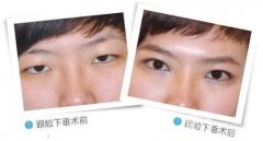 如何矯正上瞼外翻呢?眼皮外翻了怎么辦?