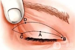 上瞼下垂可以修復(fù)嗎?如何修復(fù)上瞼下垂?