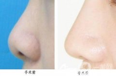 鼻尖延長(zhǎng)整形手術(shù)選擇假體還是耳軟骨好?