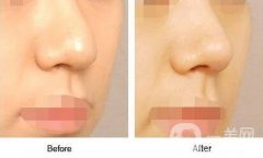 鼻尖整形價(jià)格要多少錢?術(shù)前術(shù)后注意事項(xiàng)盤點(diǎn)