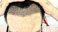 植發(fā)后多久能看到果，植發(fā)前的注意事項(xiàng)