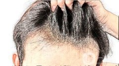 植發(fā)后脫發(fā)多長(zhǎng)時(shí)間會(huì)再長(zhǎng)?
