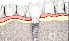 種植牙的步驟是怎么樣的?