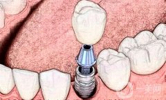 種植牙的壽命有多長?