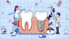 種植牙的優(yōu)缺點是什么