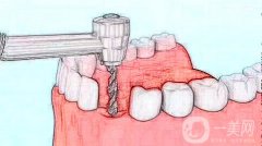 種植牙是什么樣的牙齒，種植牙好嗎