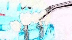 種植牙有哪危害?