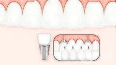 種植牙有哪些風險，有什么好處