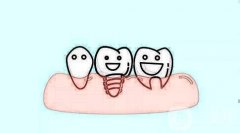 種植牙有什么好處