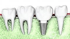 種植牙有什么缺點呢?