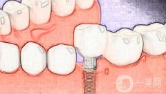 種植一顆牙需要多少錢(qián)