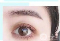 怎么判斷自己適合哪種雙眼皮嗎？埋線還是全切？