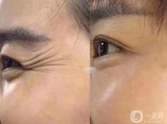 魚(yú)尾紋能注射注射除皺嗎?注射注射除皺后的注意事項(xiàng)?